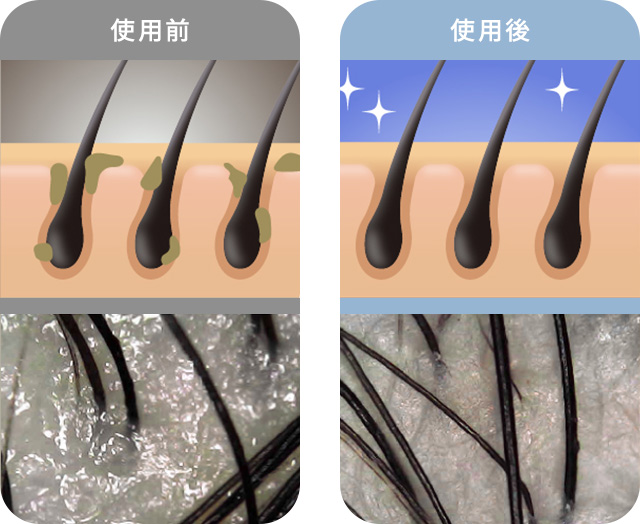 ノーエンド リフト ヘッドスパ NB-LH-001 ヘッドマッサージャー